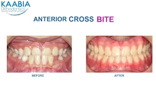 Occlusion inversée antérieur en denture mixteCorrection Anterior Crossbite of mixed dentition [upl. by Lihka]