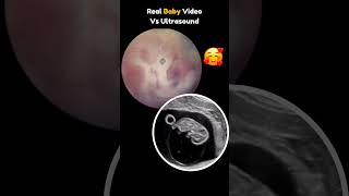 Real Baby Video Vs Ultrasound Scan 🥰 pregnancy embryo share [upl. by Dearborn]