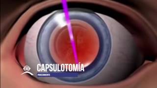 capsulotomía [upl. by Magna]