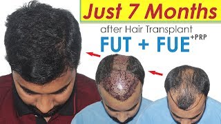 Must SEE Hair Transplant Results by COMBO TECHNIQUE  Dr Suneet  Medispa India  Jaipur Delhi  USA [upl. by Studnia]