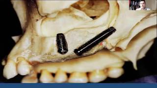 Webinar The Use of Pterygoid Implants for the Treatment of the Atrophic Maxilla [upl. by Fredrika]