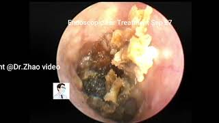 Ear wax removal Cerumen and cholesteatoma [upl. by Benson519]