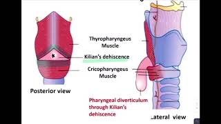 ESOPHAGEAL DIVERTICULUM [upl. by Koloski]