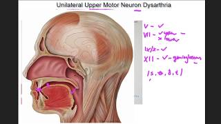 Unilateral Upper Motor Neuron Dysarthria  example and tutorial [upl. by Liane311]