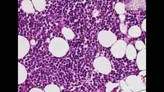 Histopathology BoneMultiple myeloma [upl. by Harry]