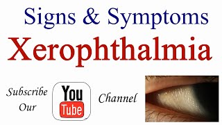 Signs and Symptoms of Xerophthalmia [upl. by Gardas]