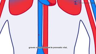 La thrombose veineuse profonde [upl. by Noraha]