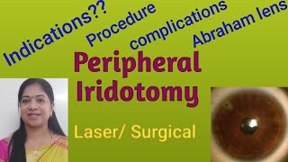 Laser peripheral iridotomyProcedureindicationsAbraham lensComplications Incisional iridectomy [upl. by Yle]