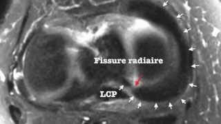 Fissure radiaire de la racine postérieure du ménisque médial  IRM 3D [upl. by Brookes787]