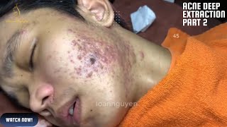 Say Goodbye to Cystic Acne Best Deep Extraction Techniques for CLEAR Skin [upl. by Latreshia426]