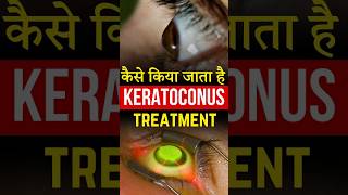 कैसे किया जाता है Keratoconus Treatment [upl. by Pansir243]