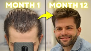 How I Regrew My Hair Using 3 Proven Treatments MonthbyMonth Results [upl. by Grane197]