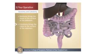 ColostomyIleostomy Your Operation [upl. by Wilen]