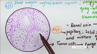 Histopathology of Renal Cell Carcinoma [upl. by Aneel]