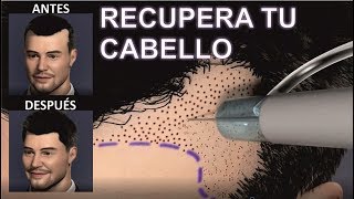 IMPLANTE o INJERTO de CABELLO 💕🙆 para MUJERES Y HOMBRES  Todas las RESPUESTAS  DR ALBERTO CALVO [upl. by Retsevlis]