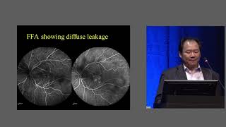 EURETINA 2018  SubLiminal laser in macular diseases [upl. by Longwood]