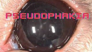 Pseudophakia  Artephakia  Ophthalmology Lecture [upl. by Venuti]