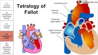 Cyanotic Congenital Heart Diseases [upl. by Azerila]