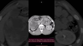 Likely possibilities a Urinary tuberculosis with right renal abscess b Neoplastic aetiology [upl. by Ecirual959]