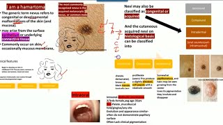 Oral nevi  Nevus HISTOPATHOLOGYjunctionalcompound and intradermalClinical features [upl. by Artur64]