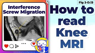 Fig 2D13 Interference Screw migration Fixation Site ACL reconstructionrelated complications [upl. by Rugen805]