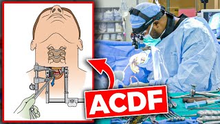 Anterior Cervical Discectomy and Fusion ACDF [upl. by Naedan]