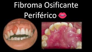 👄 Fibroma osificante periférico  Cavidad oral  Cabeza y Cuello  Patología [upl. by Rinee]