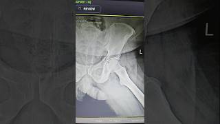 Fracture of ilium bone hip jointparamedicalclasses anatomy [upl. by Nirb]