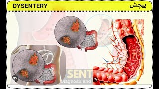 dysentery  pichesh  अतिसार [upl. by Mayworm345]