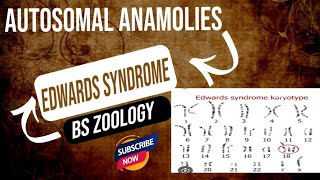 Edward syndrome  in urdu hindi  Genetics BS Zoology [upl. by Aerdnaxela]