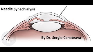 NEW NEEDLE SYNECHIOLYSIS WITHOUT VISCOELASTIC [upl. by Prudy]