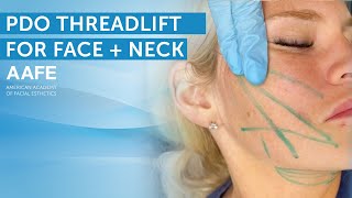 NonSurgical Face and Neck Lift with PDO Lifting Threads  AAFE [upl. by Jessabell353]