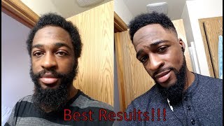 5 minoxidil journey update  Week 19 [upl. by Aihsikal]