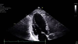 Mid Wall Stress Cardiomyopathy [upl. by Ihtraa]