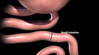 Rex Bariatrics Gastric Bypass Surgery Explained [upl. by Akkahs]