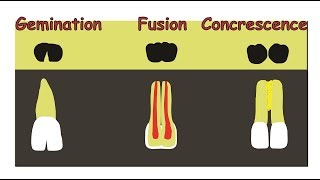 Fusion Gemination amp Concrescence [upl. by Kurtz191]