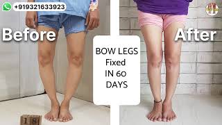 32 years old Mumbai girl operated both bowlegs BOW LEGS Fixed in 60 days Height also increased [upl. by Anthe]