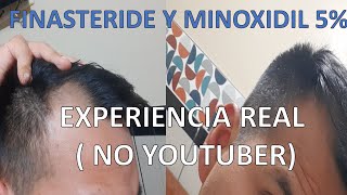 PRIMER MES DE MINOXIDIL Y FINASTERIDE CASO REAL [upl. by Barrus]