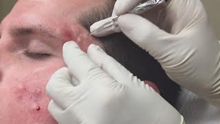 Super Satisfying Blackhead Removal [upl. by Athalie869]