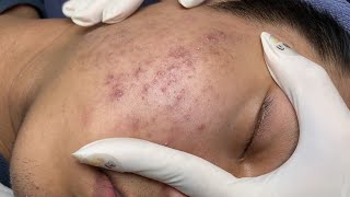 ACNE TREATMENT VU QUYNH MI Acne On Teens Chin 2024 [upl. by Hillie214]