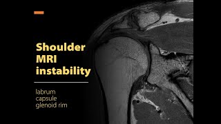 Shoulder MRI instability Labrum capsule glenoid rim [upl. by Eronaele799]