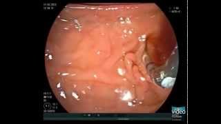 Primary Sclerosing Cholangitis and Brush Cytology Sampling [upl. by Notsuj731]