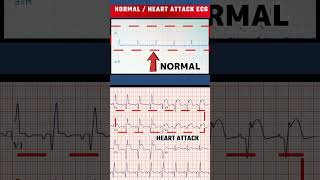 हार्ट अटैक का ECG  HEART ATTACK ECG VS NORMAL ECGshorts [upl. by Sama598]