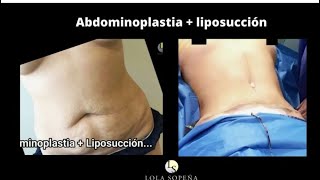 Abdominoplastia con liposucción [upl. by Serena]