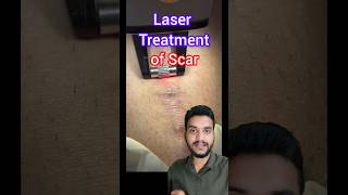 Laser treatment Keloid scar shorts [upl. by Normandy3]