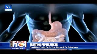 How To Treat Peptic Ulcer Health Focus [upl. by Gorton]