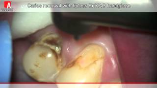 CARIES REMOVAL Fotona Lightwalker ErYAG laser [upl. by Corel]