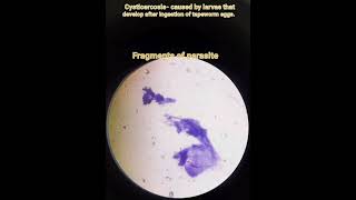 Cysticercosis Taenia solium parasitic infectionPathologyFNACCytology smear [upl. by Tarsus]