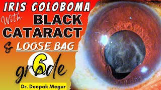 Iris Coloboma with Cataracta Nigra and a Loose Bag Grade 6  Dr Deepak megur [upl. by Bodrogi]