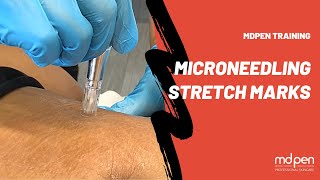 STRETCH MARKS MICRONEEDLING PROCEDURE  MDPEN TRAINING [upl. by Attebasile]